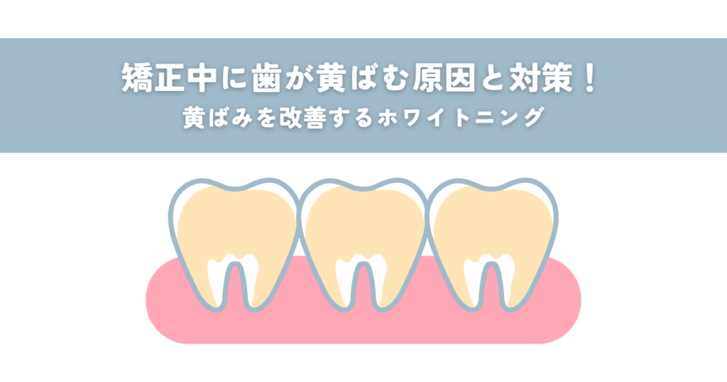 矯正中に歯が黄ばむ原因と対策！黄ばみを改善するホワイトニング